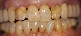 Before restorative dental procedure on a patient