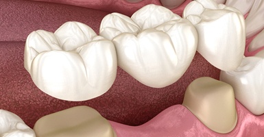 3D image of a dental bridge being put on the back teeth 