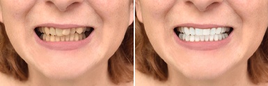 Female patient’s smile before and after full mouth reconstruction in Odessa, TX
