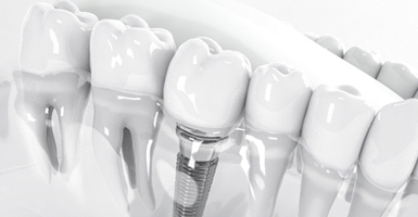 Model of dental implant in Odessa, TX with other teeth