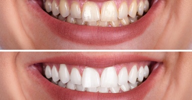 Someone’s smile before and after teeth whitening 