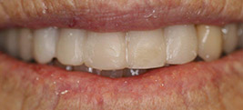 After restorative dental procedure on a patient