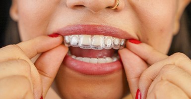 Close-up of woman placing clear aligner on upper teeth