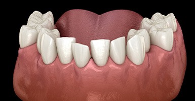Illustration of crowded teeth in lower arch
