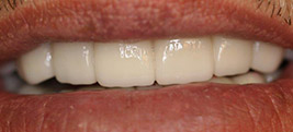 After porcelain veneers on a patient