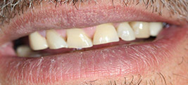 Before porcelain veneers on a patient