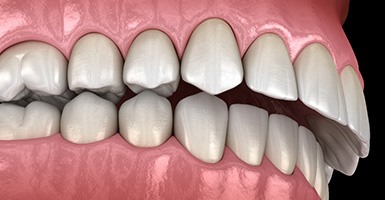 Illustration of an angled view of an overbite