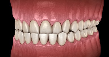 Illustration of pulled back shot of underbite