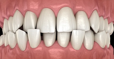 Illustration of front view of crossbite