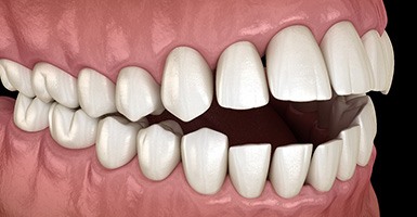 Illustration of angled view of open bite