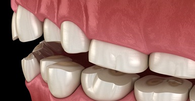A digital image of teeth that are worn down because of bruxism