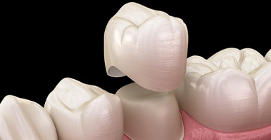 3D image of a crown being put on a tooth