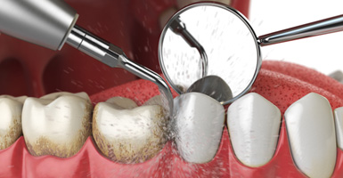 Illustration of dental instruments cleaning plaque from teeth