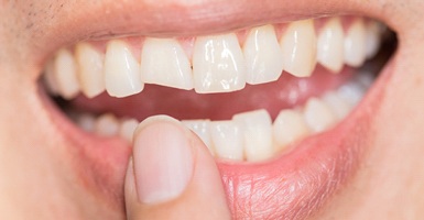 Close-up photo of a chipped front tooth