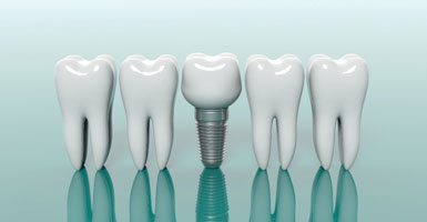 dental implant with crown in between several natural teeth