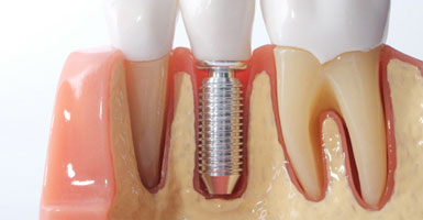 dental implant in a model of the jaw