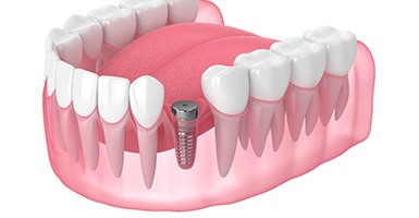 Illustration of dental implant in Odessa, TX during osseointegration