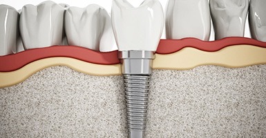 Illustration of dental implant after crown has been placed