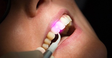 Photo of a soft tissue laser being used for gum recontouring