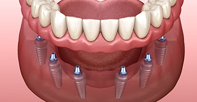 Illustration of strong implant dentures for lower arch