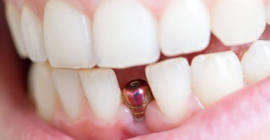 Close-up of dental implant in Odessa, TX before restoration