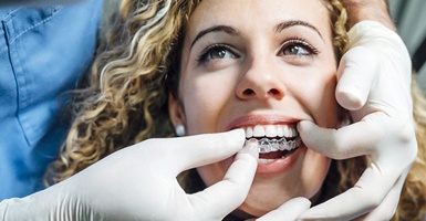 A dentist inserting an Invisalign aligner in a female patient’s mouth during her fitting