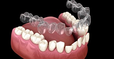 A digital image of an Invisalign aligner going on over the lower arch of teeth