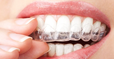 A woman putting in a teeth whitening tray