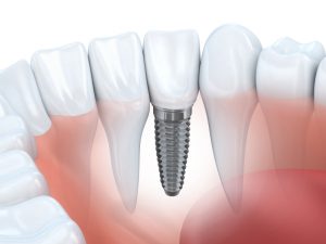 dental implants in odessa