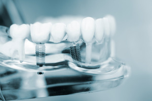 Illustration of dental implants in a plastic model of mouth