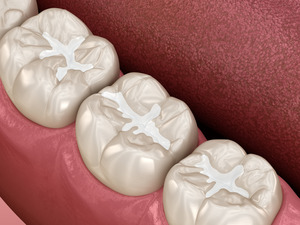 Illustration of teeth with tooth-colored fillings
