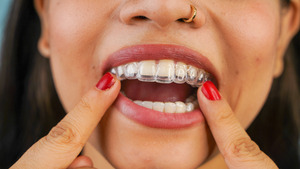 Woman placing Invisalign aligners on her teeth